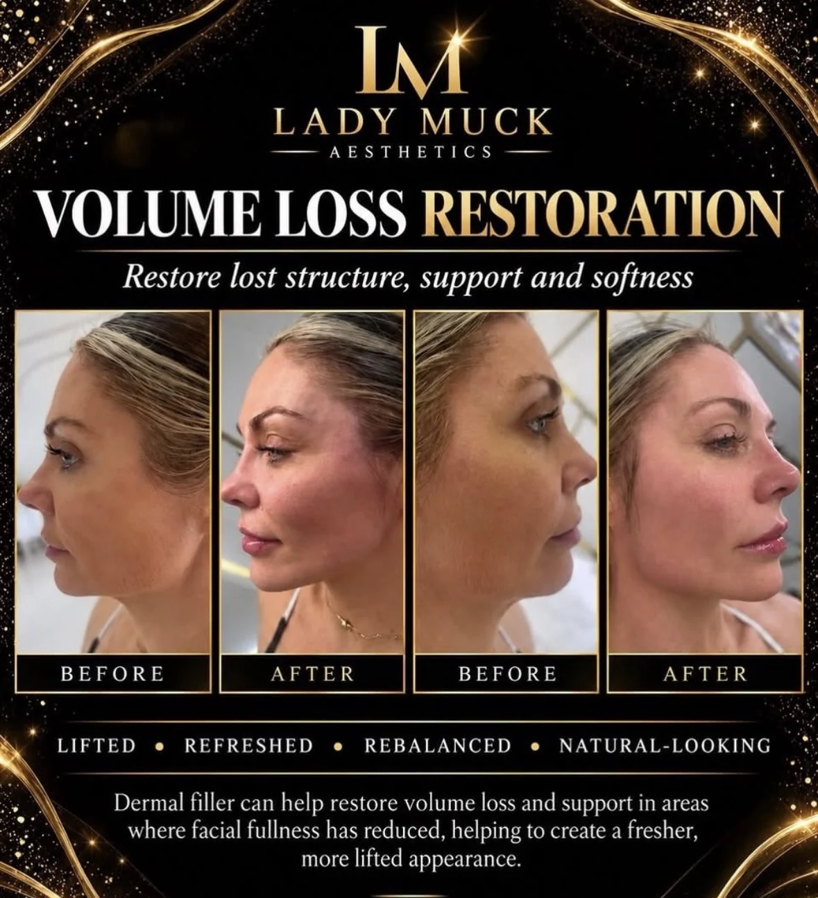 Volume loss restoration before and after