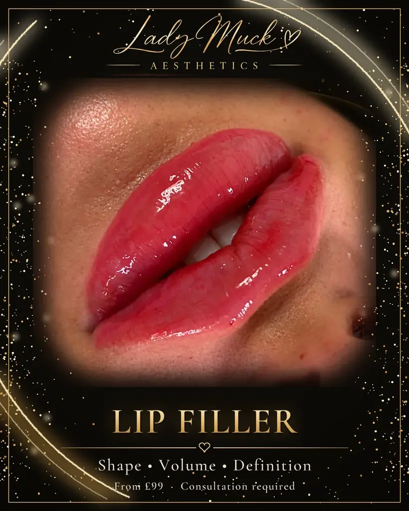 Lip filler before and after