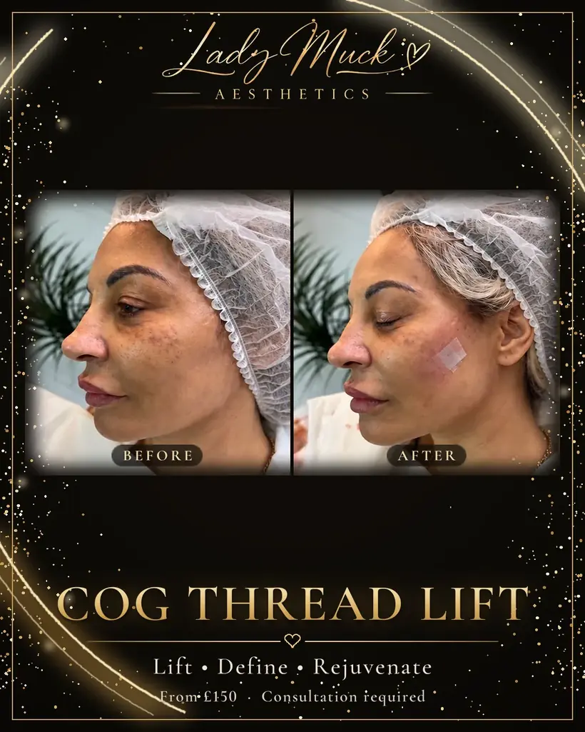 Cog thread lift before and after