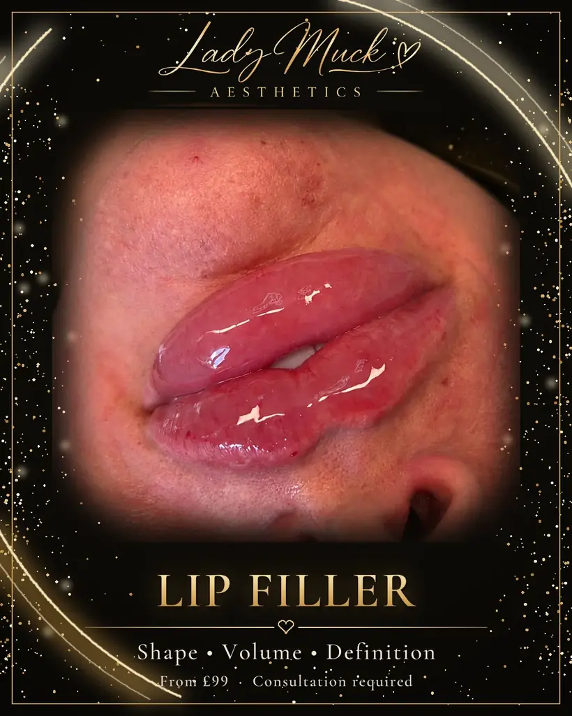 Lip filler before and after