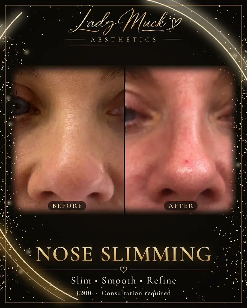 Nose slimming before and after