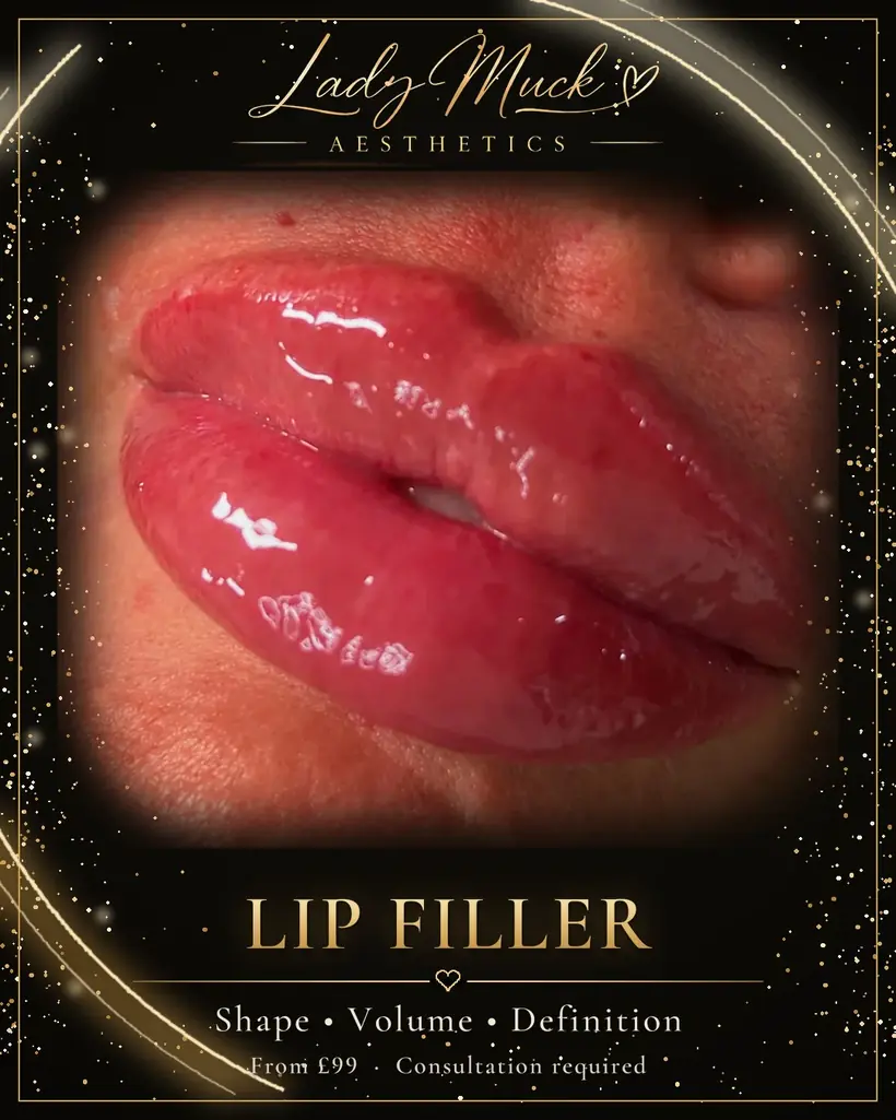 Lip filler before and after