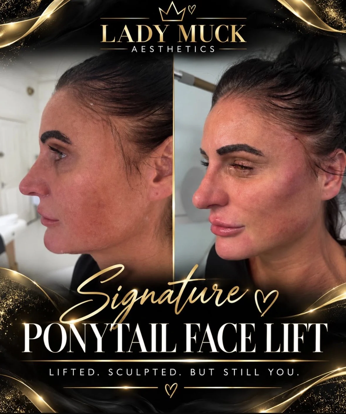 Signature ponytail face lift before and after