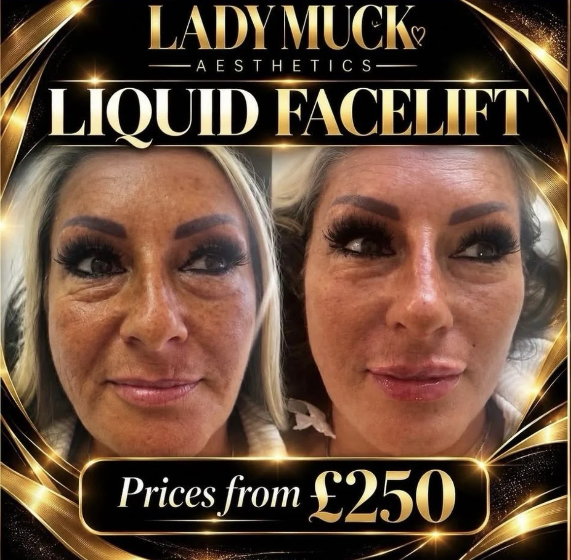 Liquid facelift before and after