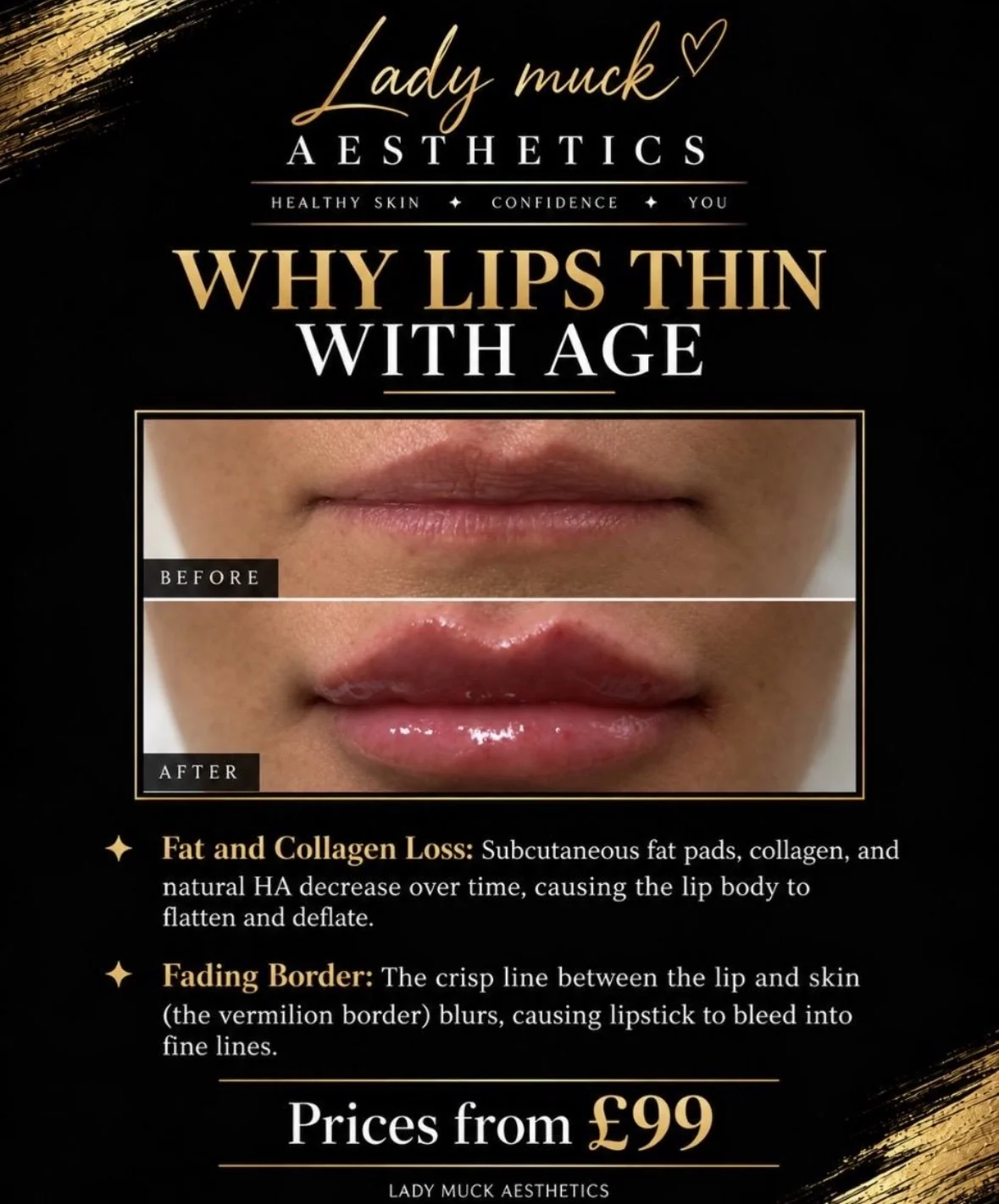 Why lips thin with age before and after