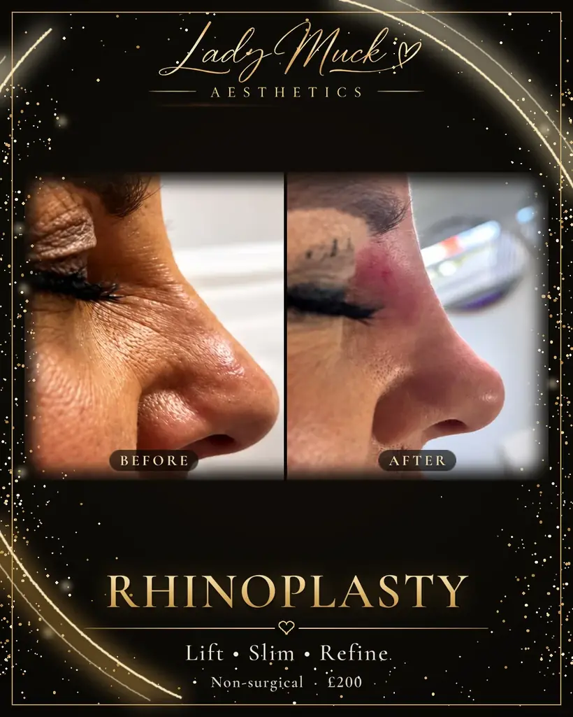 Non-surgical rhinoplasty before and after
