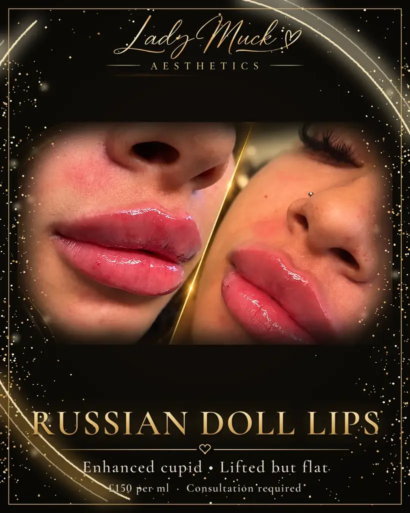 Russian doll lips before and after