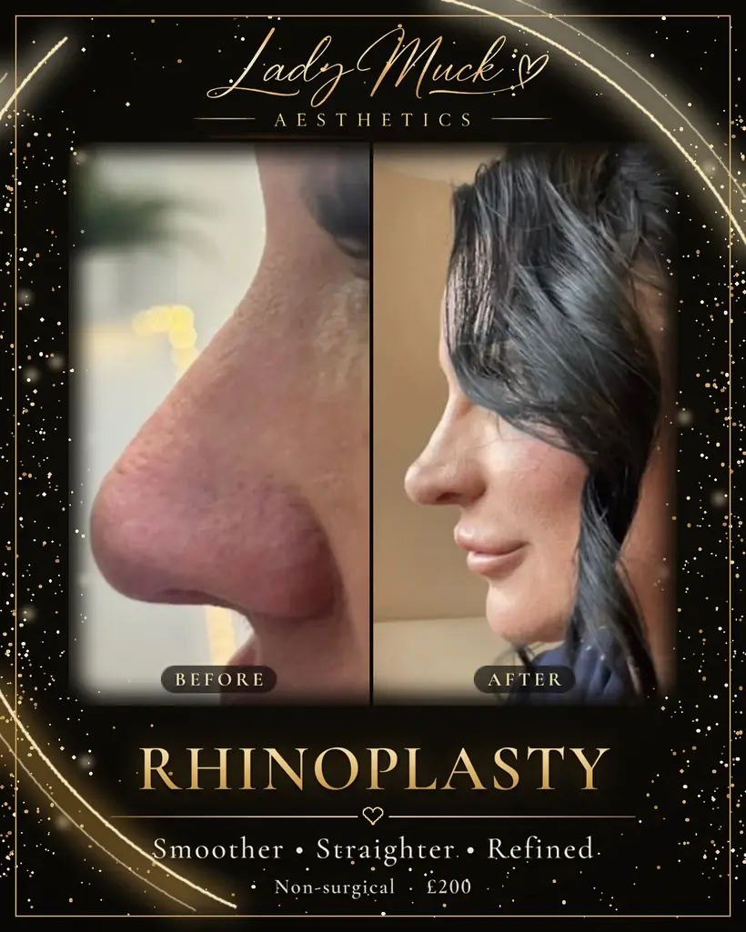 Non-surgical rhinoplasty before and after