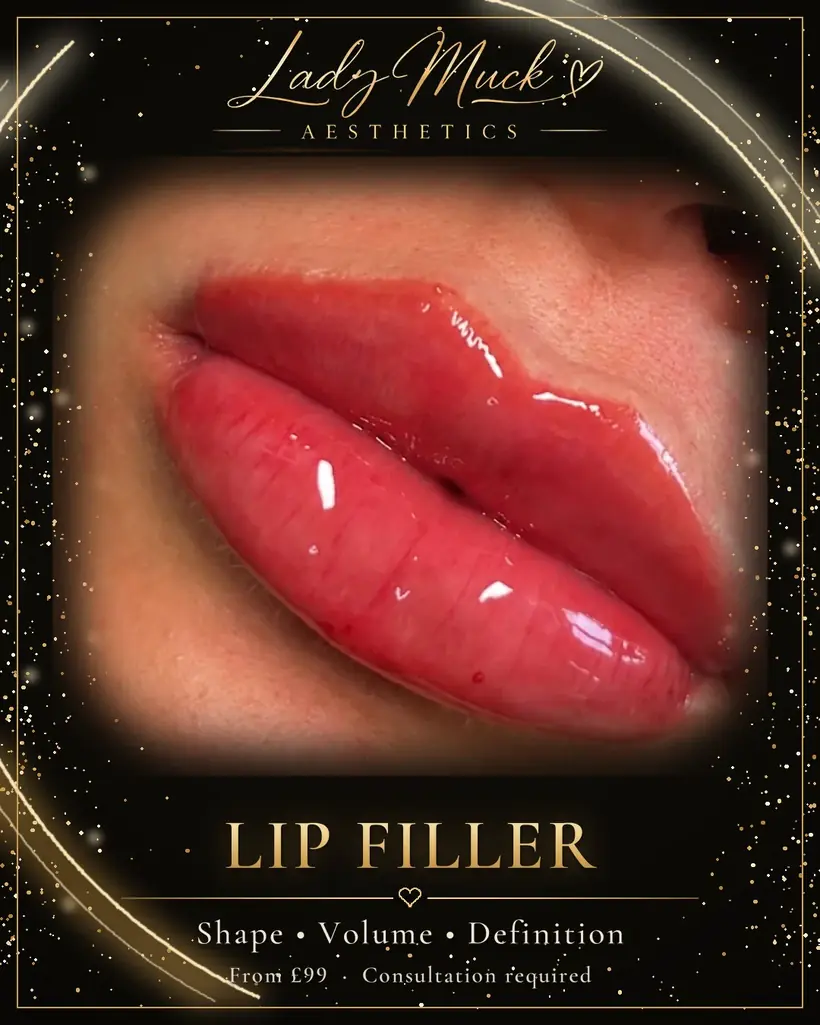 Lip filler before and after