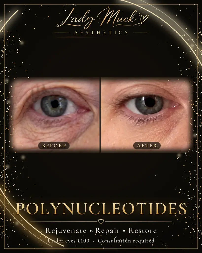 Polynucleotides: under eyes before and after