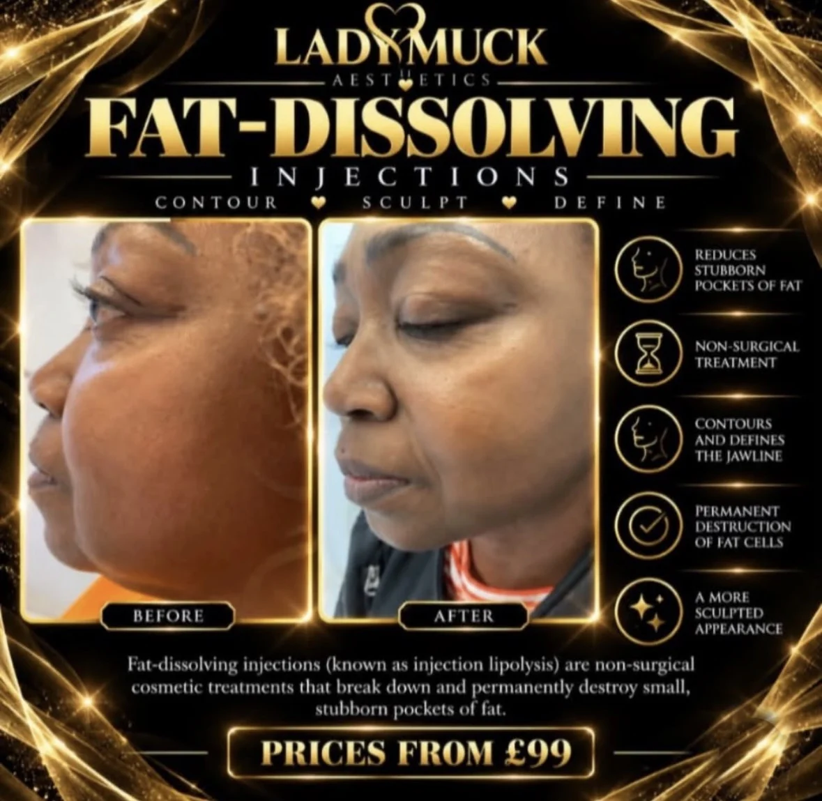 Fat-dissolving injections before and after