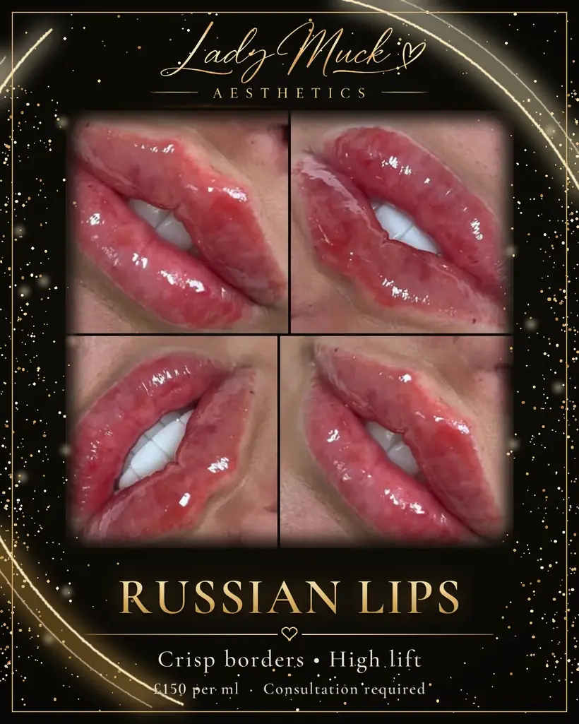 Russian lips before and after