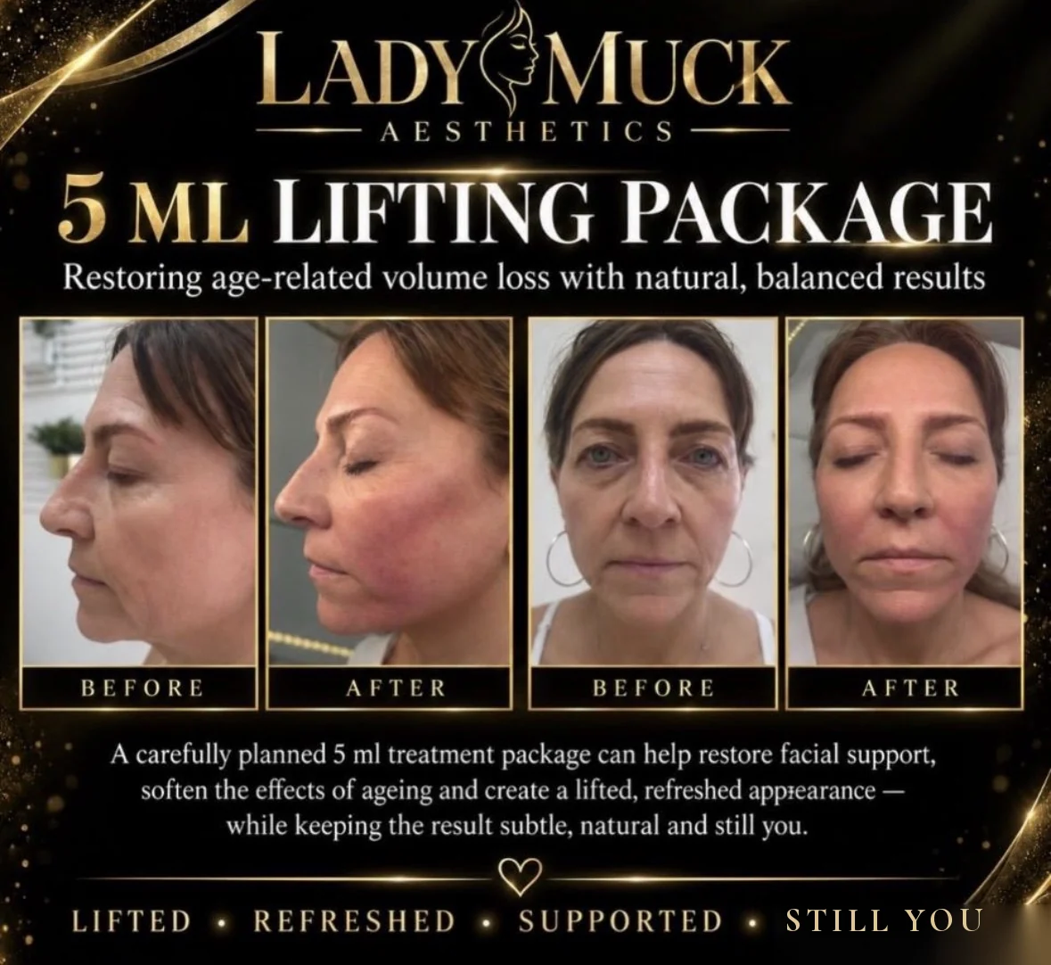 5 ml lifting package before and after