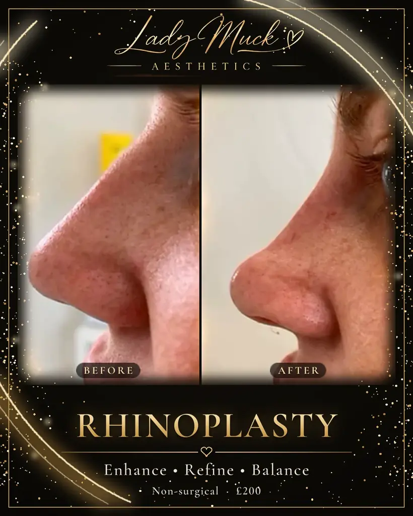Non-surgical rhinoplasty before and after