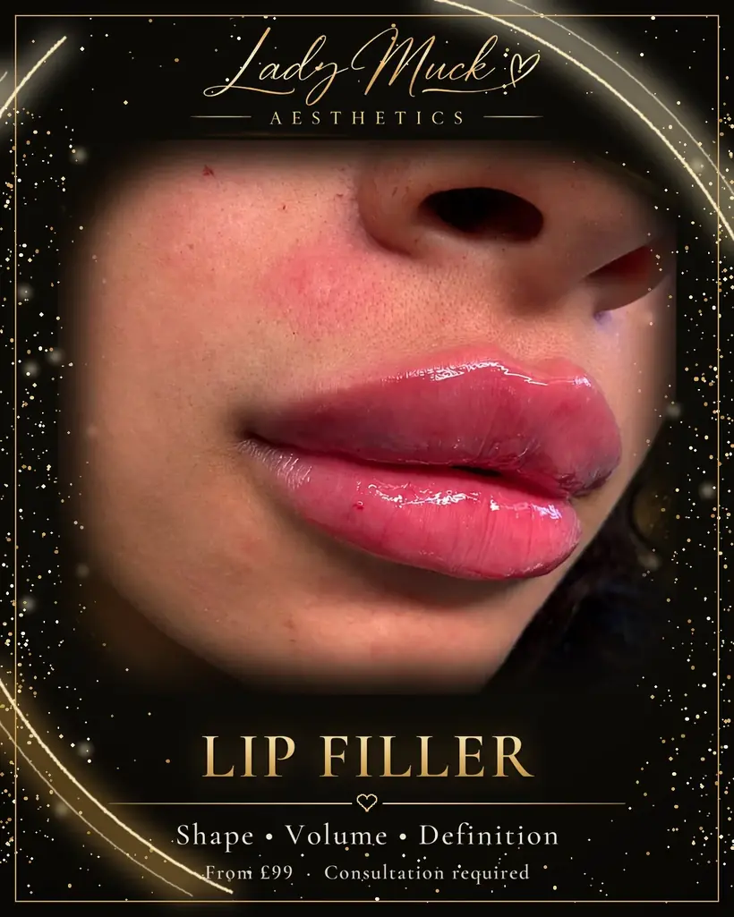 Lip filler before and after