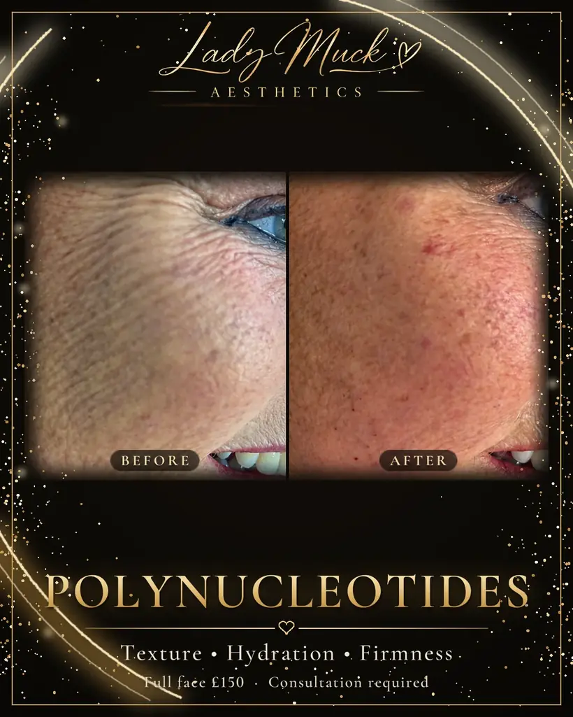 Polynucleotides: skin rejuvenation before and after