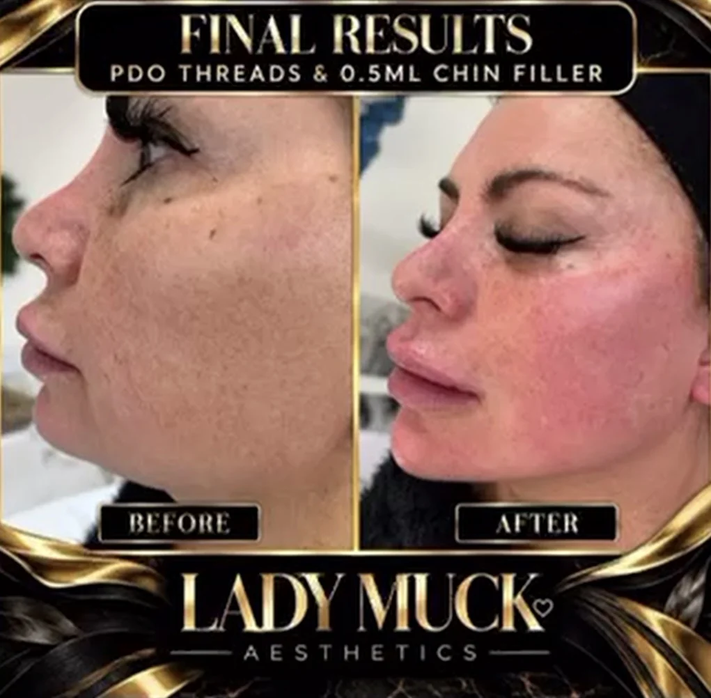 PDO threads & chin filler before and after