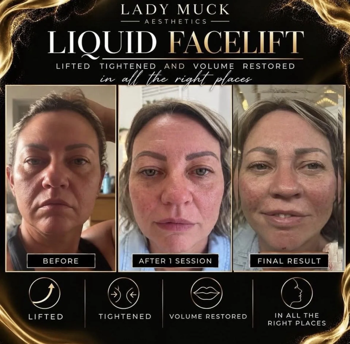 Liquid facelift, 3 stages before and after