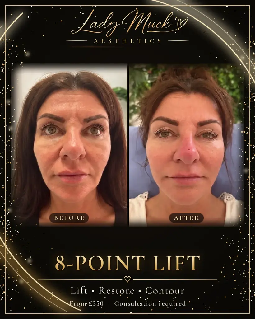 8-point lift before and after