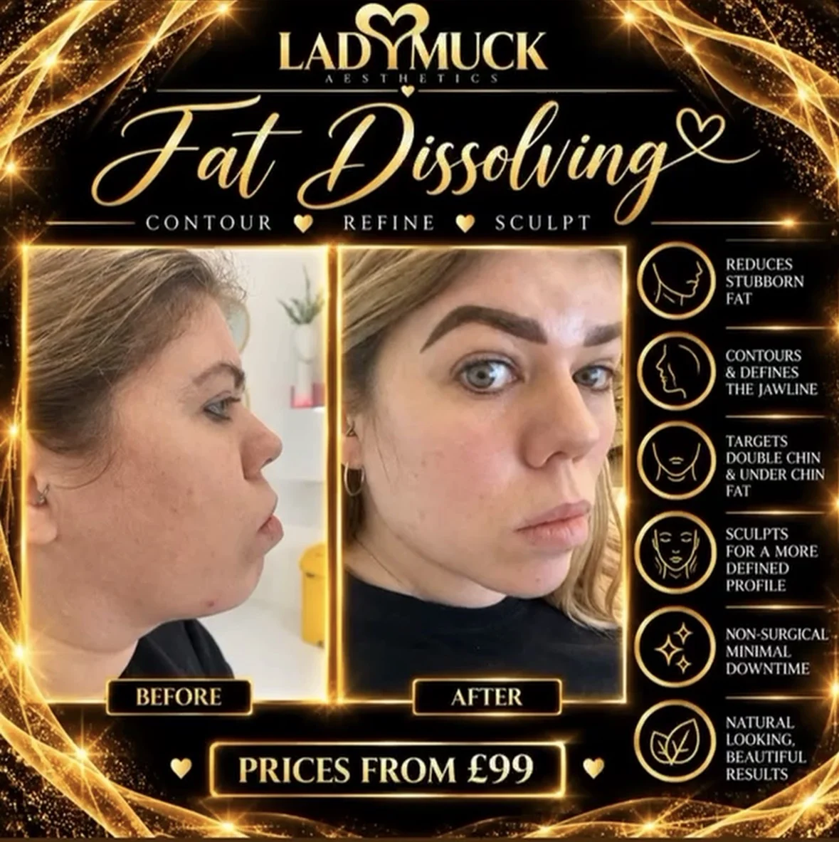 Fat dissolving before and after