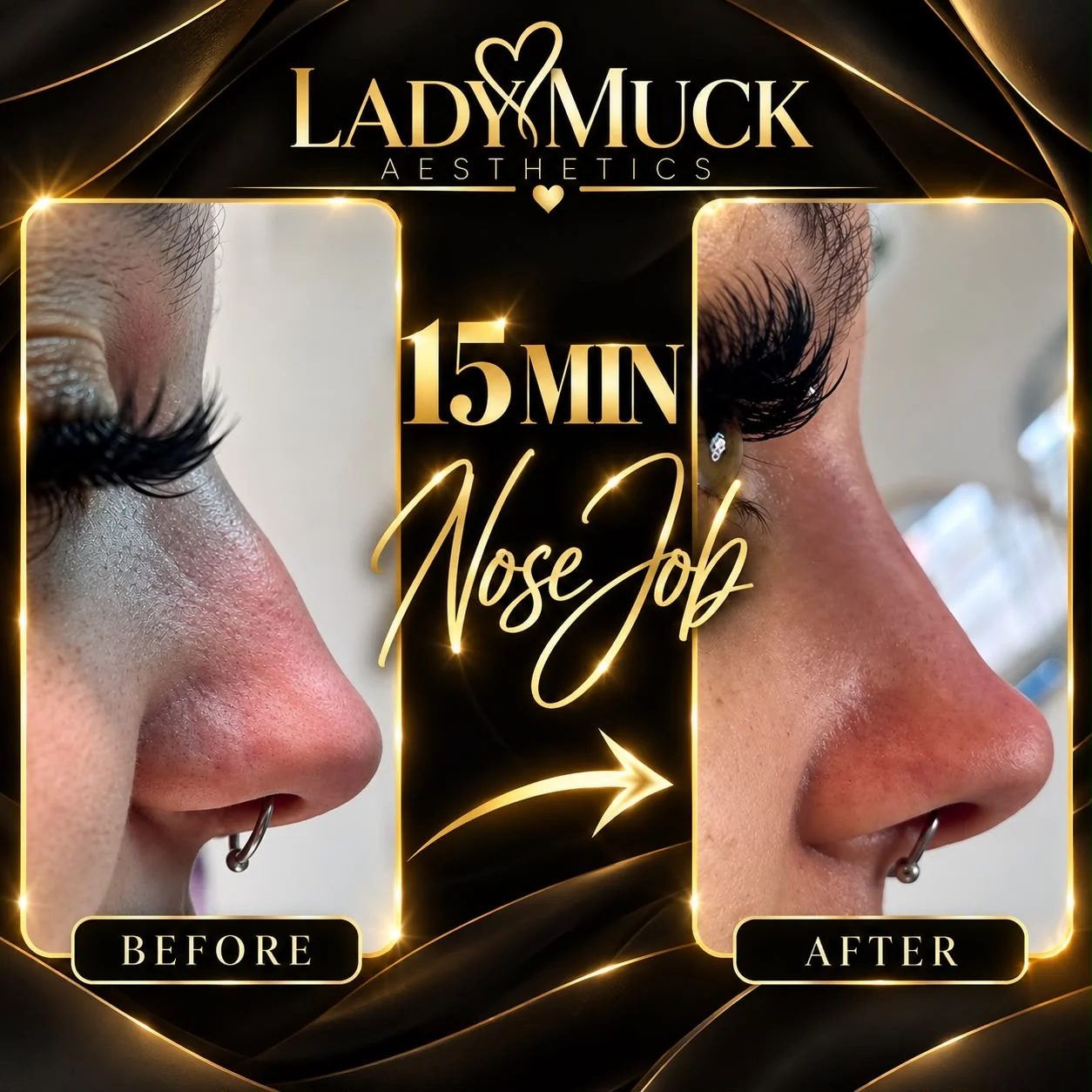 15 minute nose job before and after