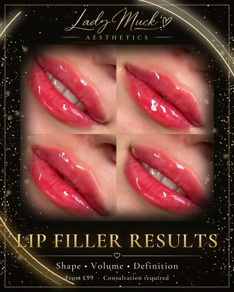 Lip filler results before and after